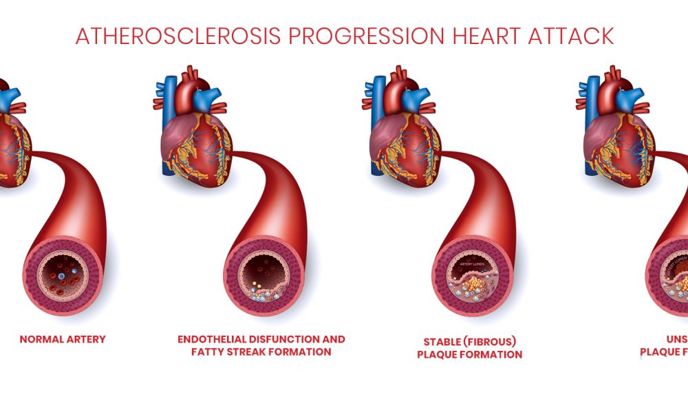 Are You at Risk of Cardiovascular Disease?