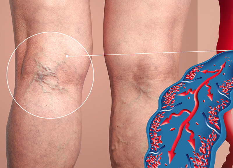 Varicose Veins