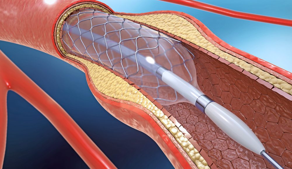 Catheter-based Heart Procedures? – A Standard Shift from Groin to Arm Access for Safety