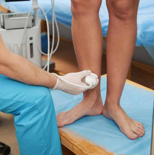 Varicose Veins Feel Like