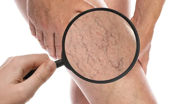 What are Varicose Veins