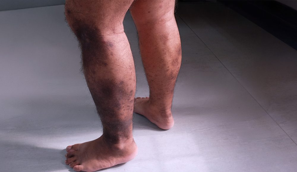 Chronic Venous Insufficiency – A Peek Into Cardiovascular Health