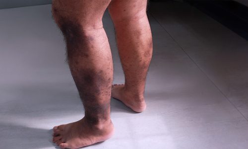 Chronic Venous Insufficiency – A Peek Into Cardiovascular Health