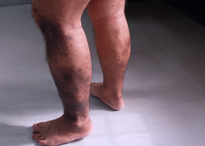 Chronic Venous Insufficiency - A Peek Into Cardiovascular Health