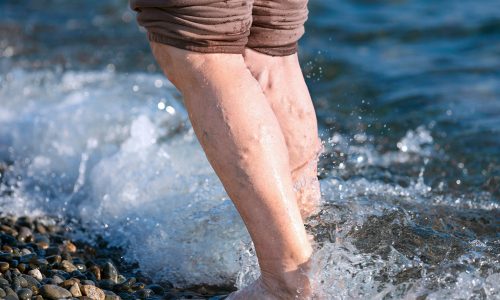 Height and Varicose Veins: Is There Any Link?