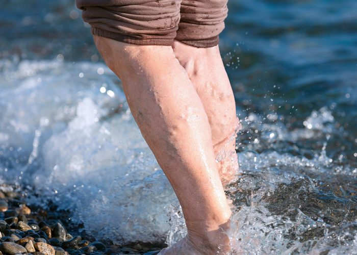 Height and Varicose Veins: Is There Any Link?