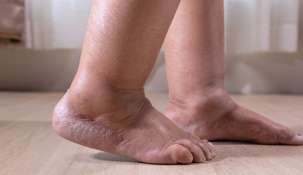 Is Your Leg Swelling Caused by Lymphedema or Chronic Venous Insufficiency?