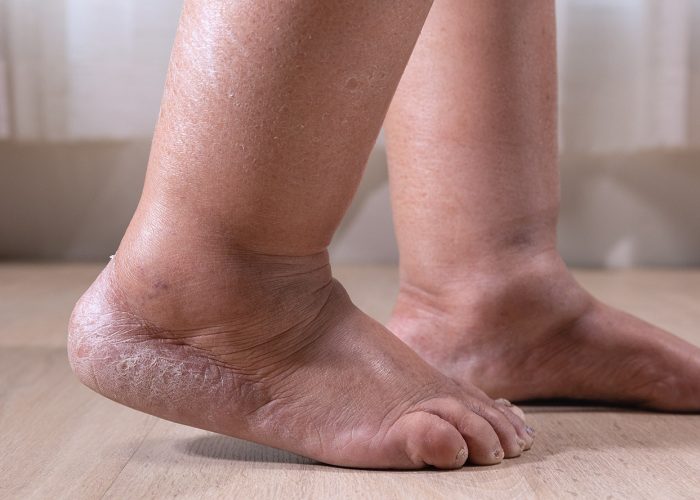Is Your Leg Swelling Caused by Lymphedema or Chronic Venous Insufficiency?