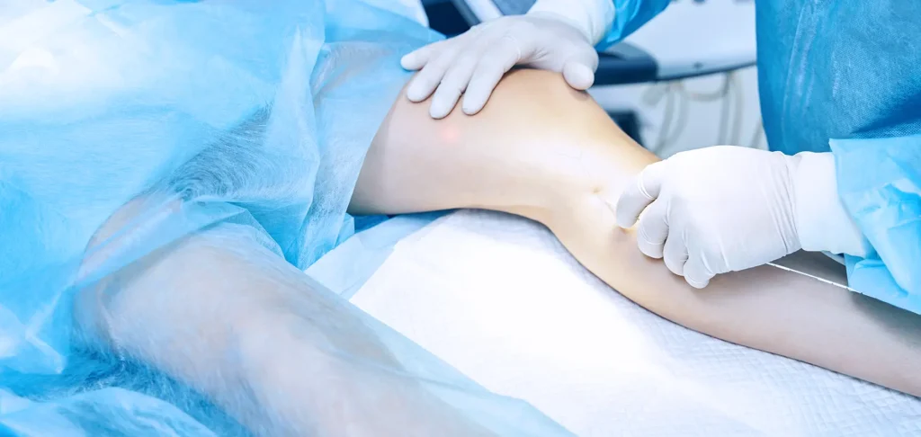 How Laser Treatment for Varicose Veins Works