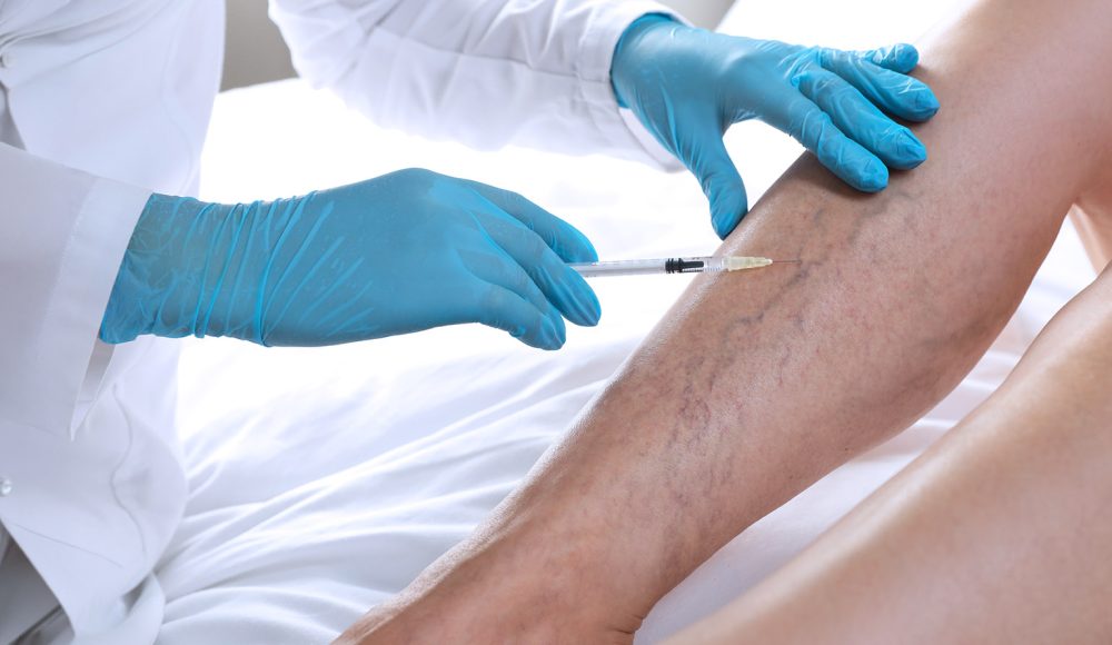 Laser Vein Treatment vs. Sclerotherapy: What’s the Real Difference?
