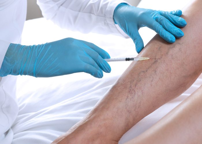 Laser Vein Treatment vs. Sclerotherapy: What’s the Real Difference?