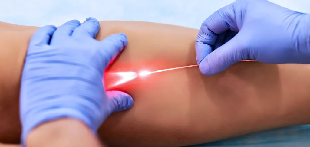 What is the difference between RFA and laser ablation?