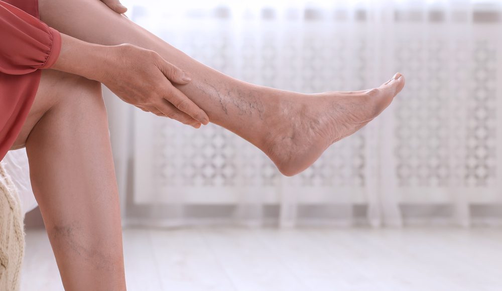 Why Women Are More Likely to Develop Varicose Veins & What to Do About It
