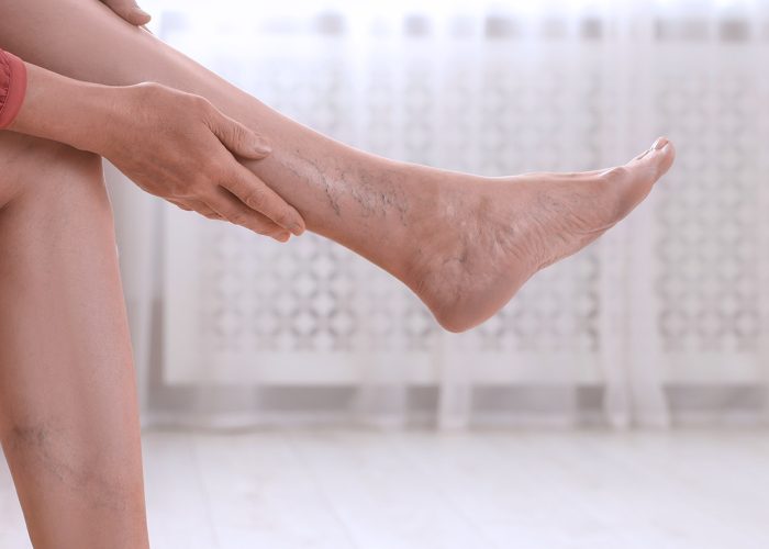 Why Women Are More Likely to Develop Varicose Veins & What to Do About It