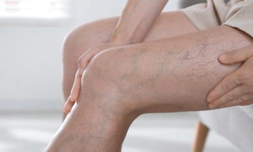 Myths and Facts About PAD: What September’s Awareness Month Wants You to Know